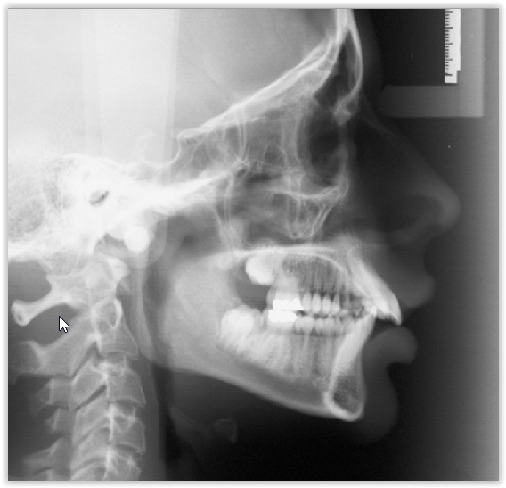 Téléradiographie Orthodontique