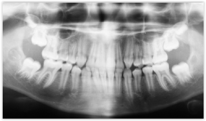 Radiographie panoramique