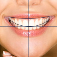 Analyse orthodontique gratuite 