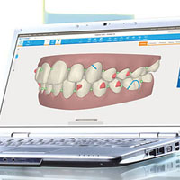Approuvez l'alignement informatisé de vos dents